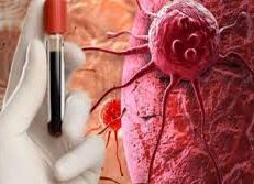 ابتكار علاج جديد لـ "سرطان الدم"