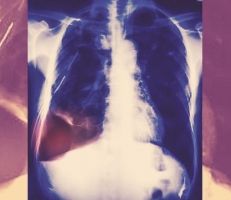 دراسة جديدة: واحد من كل مائة مريض كورونا يعاني من ثقب في الرئة