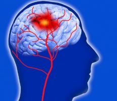 ما هي السكتة الدماغية وكيف  يمكن تقليل مخاطرها