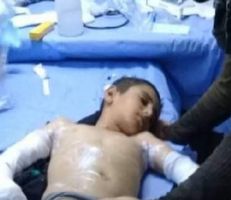 بعد بتر 3 أطراف للطفل يزن محمد: العلاج مستمر في مشفى تشرين العسكري