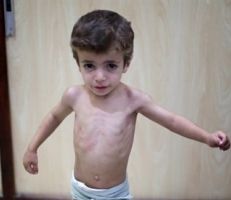 بسبب سوء التغذية.. السوريون مقبلون على واقع ظهور أجيال ذات بنية ضعيفة و"قامات مقزمة"