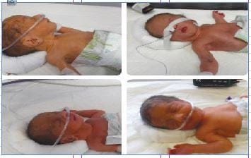 في حالة نادرة ولأول مرة في اللاذقية ولادة خمسة توائم
