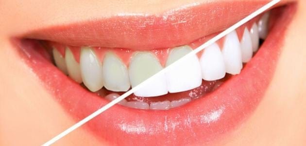 دراسة في جامعة ستوكتون تحذر من خطر تبييض الأسنان