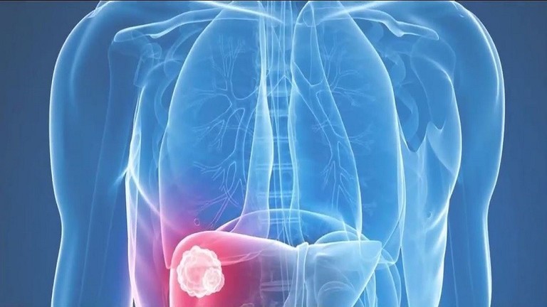 دواء "ألوفانيب" لعلاج سرطان المعدة
