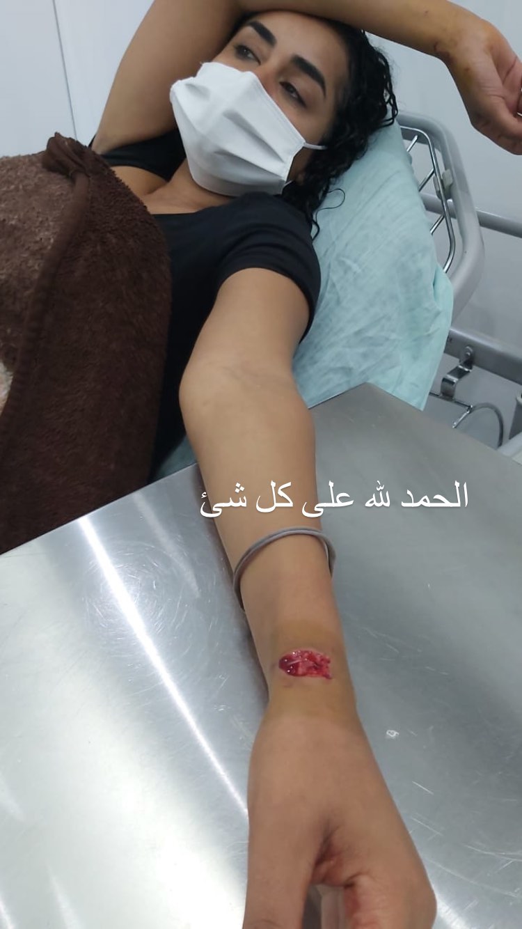 فنانة مصرية تنشر أول صورة لها بعد إصابتها بجرح عميق في انفجار بيروت..