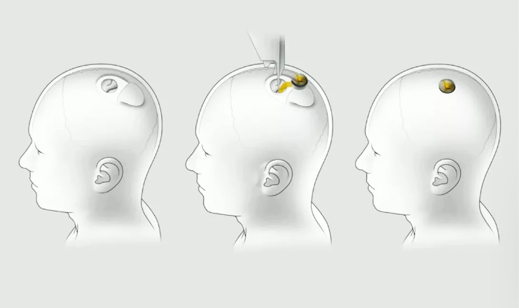 شركة نيورالينك تكشف عن زراعة شريحة كومبيوتر في دماغ خنزير
