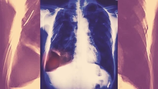 دراسة جديدة: واحد من كل مائة مريض كورونا يعاني من ثقب في الرئة