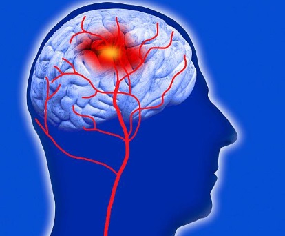 خبراء أوروبيون يطورون تقنية لاختبار عوامل خطورة الإصابة بالسكتة الدماغية