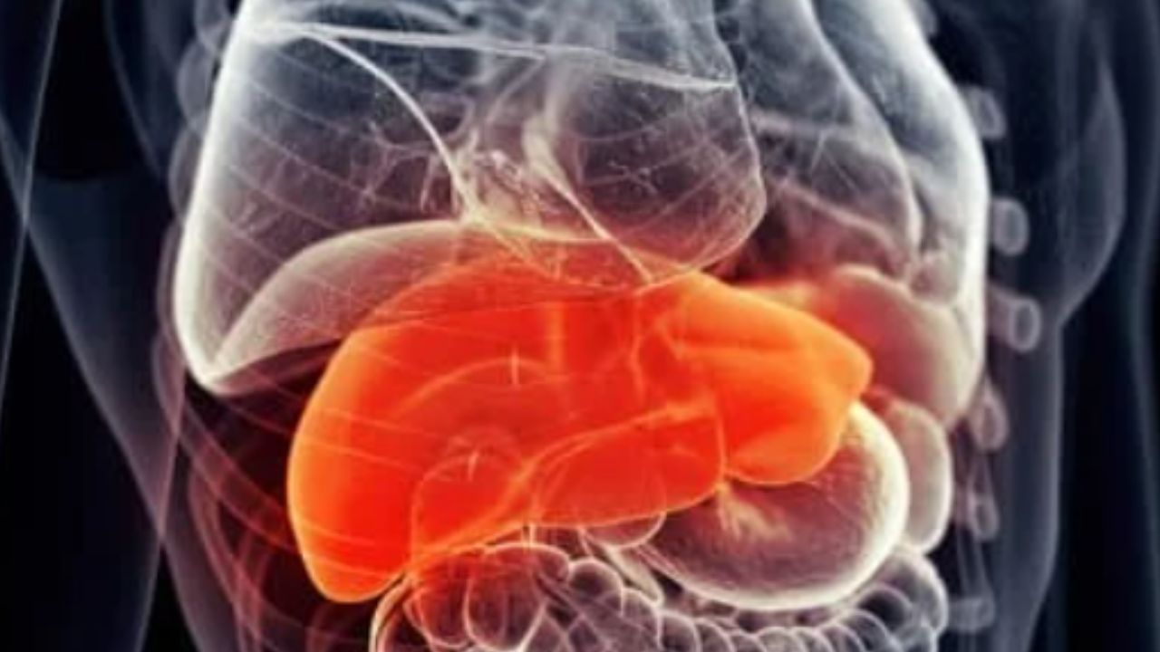 دراسة: الكبد الدهني يزيد من خطر الإصابة بالخرف بنسبة 50%
