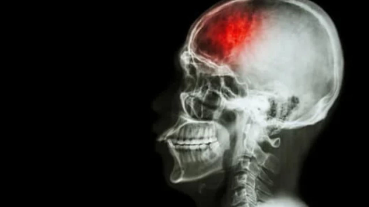 السكتة الدماغية تصيب الشباب أيضا وهذه هي العلامات التحذيرية
