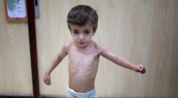 سوء التغذية يزيد حالات تقزم الأطفال في سورية