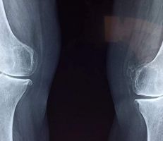 نصائح طبية للتعامل مع إصابات كسور العظام