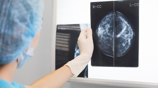 الذكاء الصناعي يتفوق على الأطباء في تشخيص سرطان الثدي